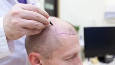 زراعة الشعر في تركيا 2022 2023 معلومات تفصيلية