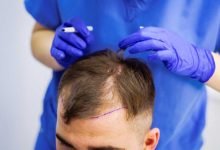 زراعة الشعر في السعودية 2022 2023 معلومات تفصيلية